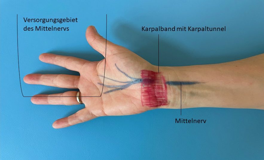 Foto einer Hand mit Beschriftung der wichtigsten Strukturen beim Karpaltunnelsyndrom