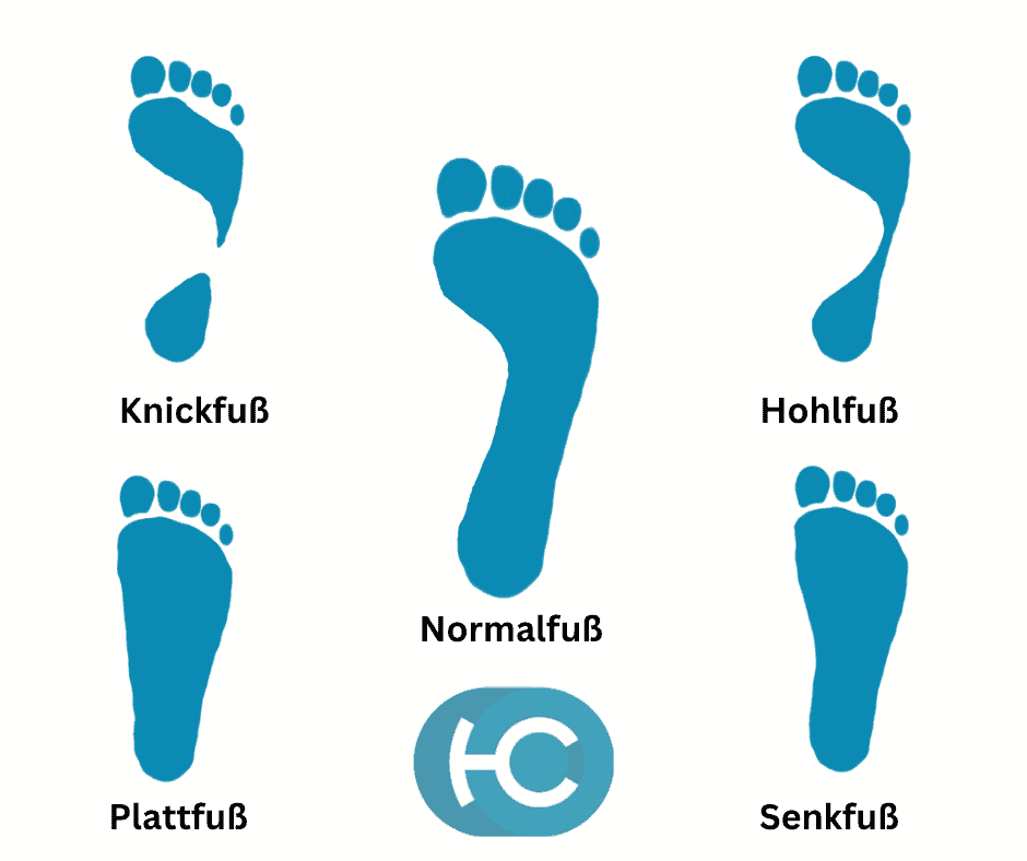 Darstellung der verschiedenen Möglichkeiten von Fußfehlstellungen